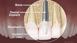 implants service